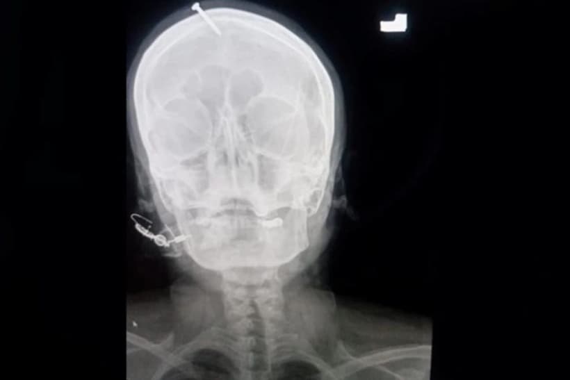 A mujer embarazada le perforan con un clavo el cráneo; buscaban que tuviera un&nbsp;niño.